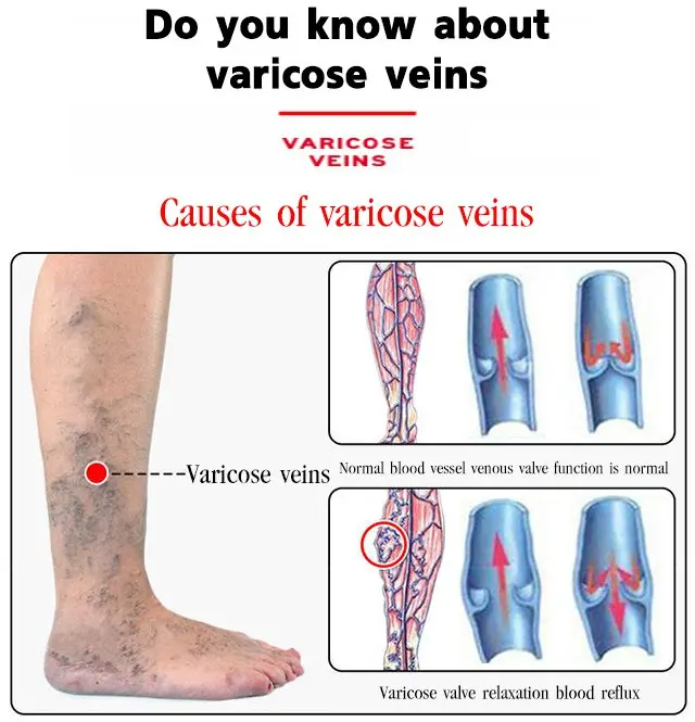 Varicose Veins Treatment Cream