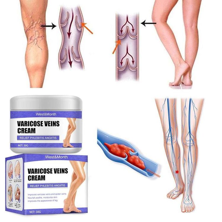 Varicose Veins Treatment Cream